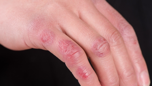 close up of female hand with chilblain on black background