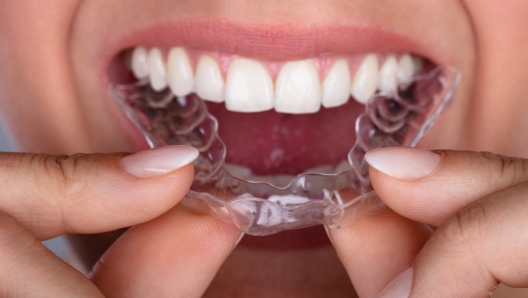 Close-up Of A Woman's Hand Putting Transparent Aligner In Teeth