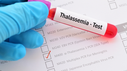 Talassemia