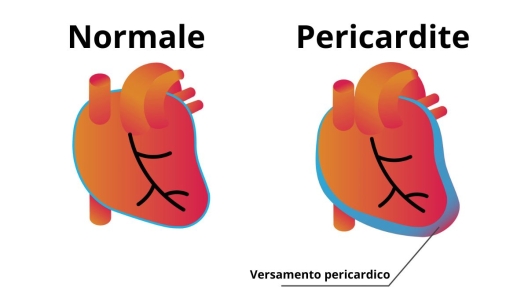 Differenza pericardite e cuore normale