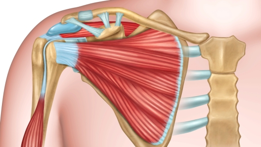 Lesione del tendine del sovraspinato