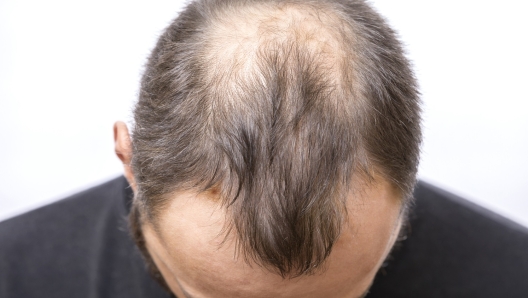 Quanti capelli si perdono con lo shampoo