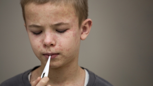 Epidemia di Morbillo in Italia numeri e pareri