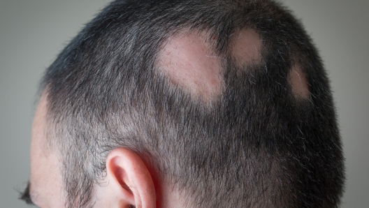 Alopecia areata: il farmaco la cui efficacia è confermata da studi scientifici