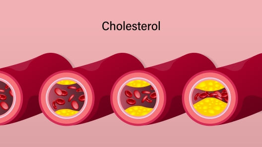 stage of cholesterol accumulation in blood vessels. Atherosclerosis. Clogged arteries caused by cholesterol.