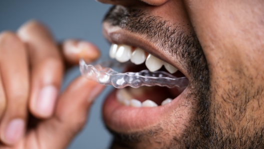 Close-up Of A Man's Hand Putting Transparent Aligner In Teeth