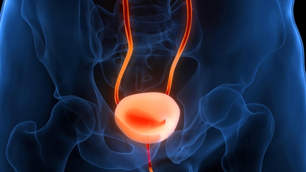 Un nuovo test delle urine potrebbe aiutare a curare il cancro alla vescica