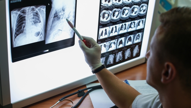 Tumore al polmone: arrivano i farmaci-scudo per prevenirlo