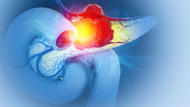 Tumore al pancreas: scoperto in Spagna un mix di tre farmaci che elimina il cancro nei topi