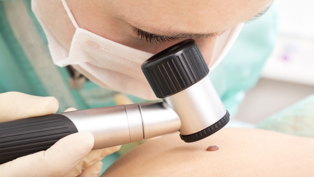 Melanoma: ecco come si può eliminare senza intervento chirurgico