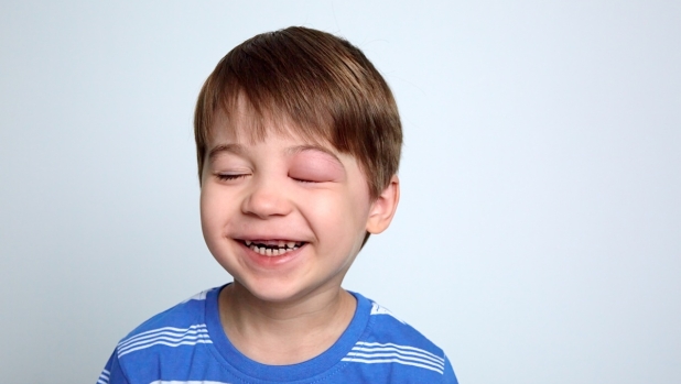 Angioedema ereditario: come non confonderlo con un'allergia