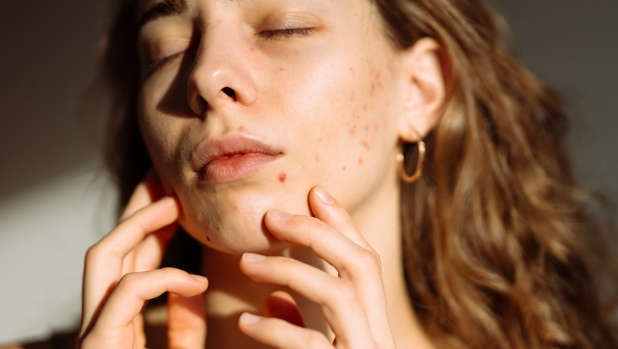 Perché l’acne peggiora d’estate? Come comportarsi per gestirla col caldo? Parla l’esperto