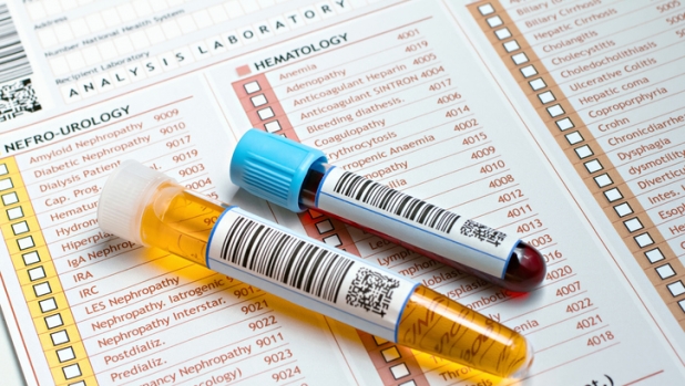 Tumore alla vescica: addio cistoscopia? Un test fai da te scova 9 casi su 10