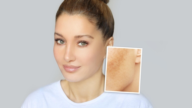 Dark spots, freckles,hyperpigmentation(melasma or chloasma),concept- skin lightening, skin whitening, Skin Brightening