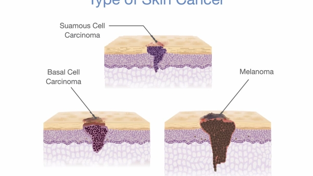 tumore della pelle prevenzione e cura