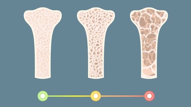 Le fasi osteoporosi