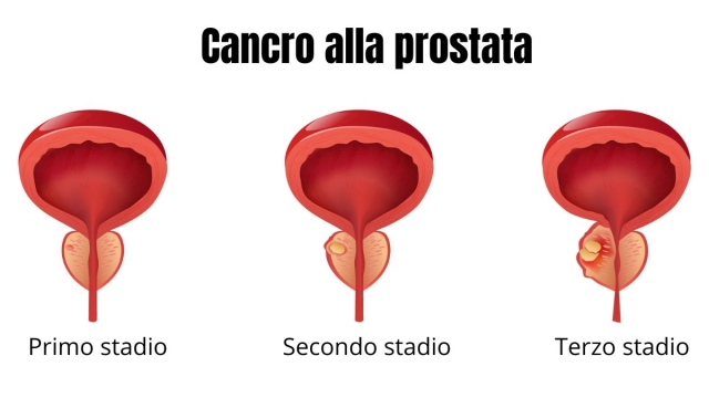 Primi tre stadi del cancro alla prostata immagine