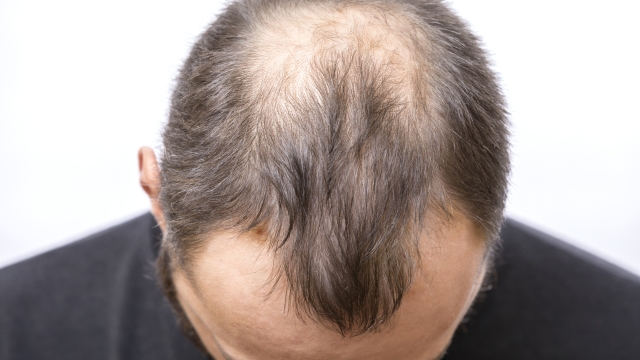 Balding young man, Hair loss problem