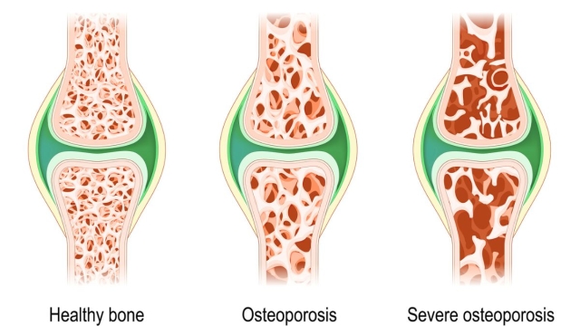Stadi Osteoporosi cause e fattori di rischio