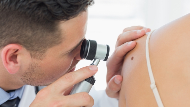 Closeup of male dermatologist checking mole on woman in clinic