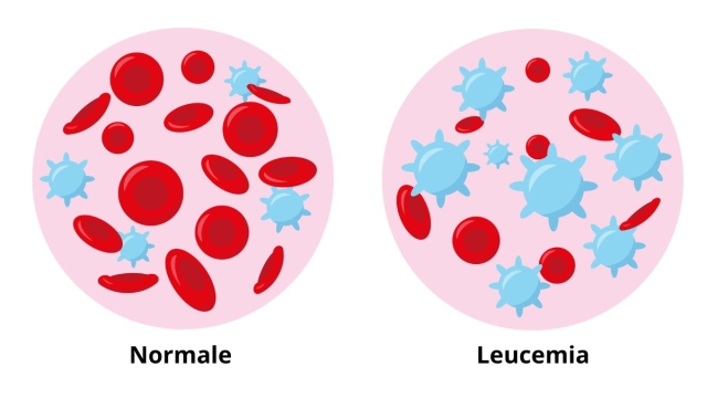 Diversi tipi specifici di leucemia