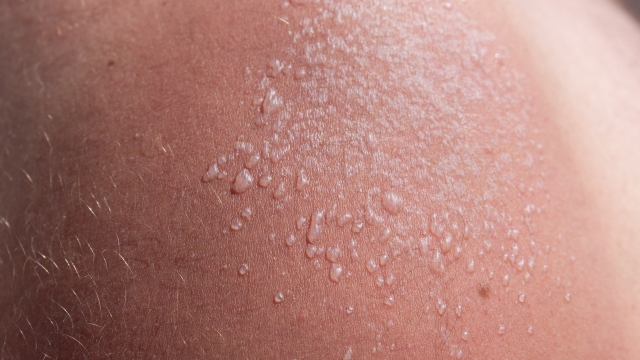 fresh sunburn on a man's shoulder. use uv protection
