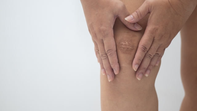 Knee scars caused by accidents