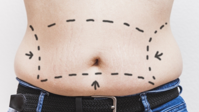 The belly of an unrecognizable fat man with painted lines and arrows for liposuction.