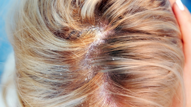 Dandruff in the hair and scalp.Dandruff, dermatitis on the head of a girl. Seborrheic lichen.