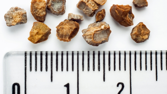 Kidney stones after ESWL intervention. Lithotripsy. Scale in centimeters