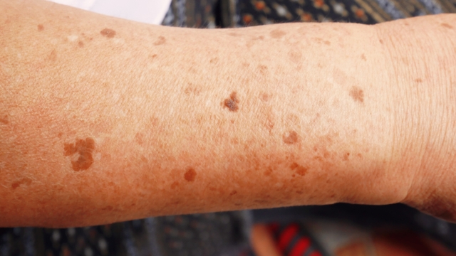 Dark spots on the skin on the arm.