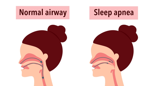 Obstructive sleep apnea syndrome concept vector illustration.