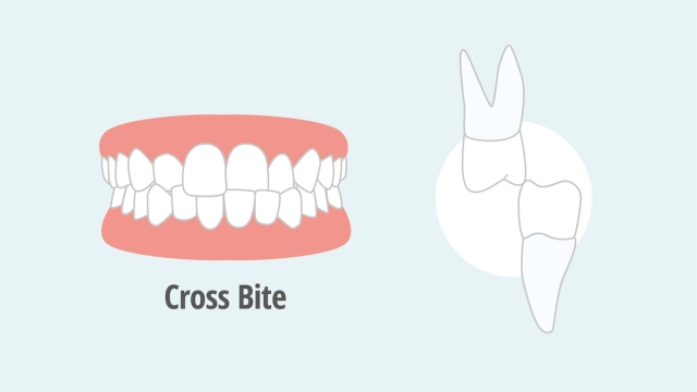Cross bite per malocclusione dentale