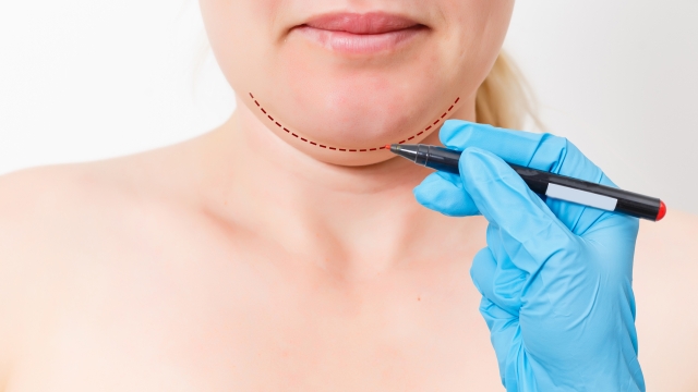 Chin reduction augmentation double chin removal plastic surgery cosmetic operation concept Woman eyes closed waiting doctor surgeon hands to draw the cut line the double chin isolated white background