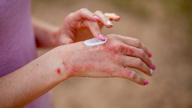 Eczema rimedi efficaci secondo la scienza