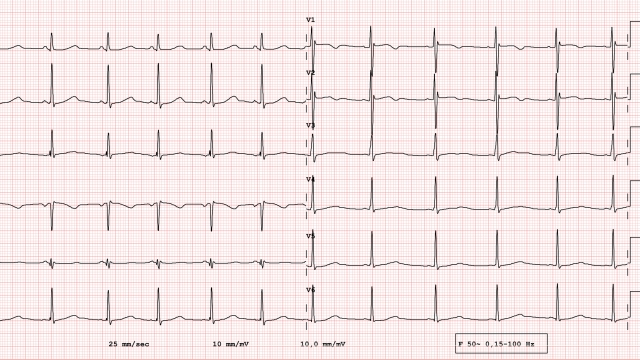 ECG example of a pathological 12-lead rhythm. Long QT syndrome, real exam