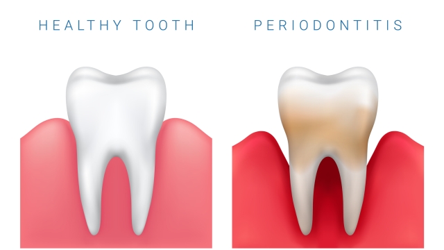 Vector medical illustration of realistic healthy tooth and periodontitis disease