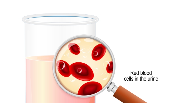 Hematuria is the presence of red blood cells in the urine (causing red discoloration). magnifying glass and beaker with urine. Closeup of Red blood cells. Vector diagram for medical, biological and scientific use