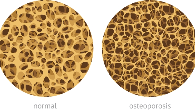 Bone spongy structure vector illustration, normal and with osteoporosis
