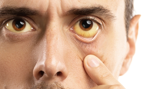 Man checking his health condition. Yellowish eyes is sign of problems with liver, viral infection or other disease.