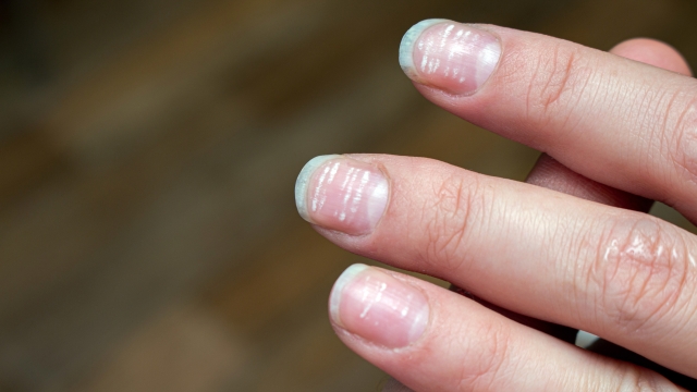 vitamin deficiency avitaminosis anemia nail problem with white dots