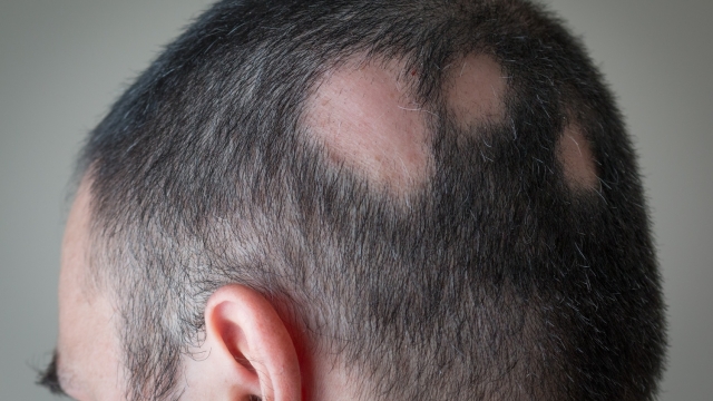 Alopecia areata: il farmaco la cui efficacia è confermata da studi scientifici