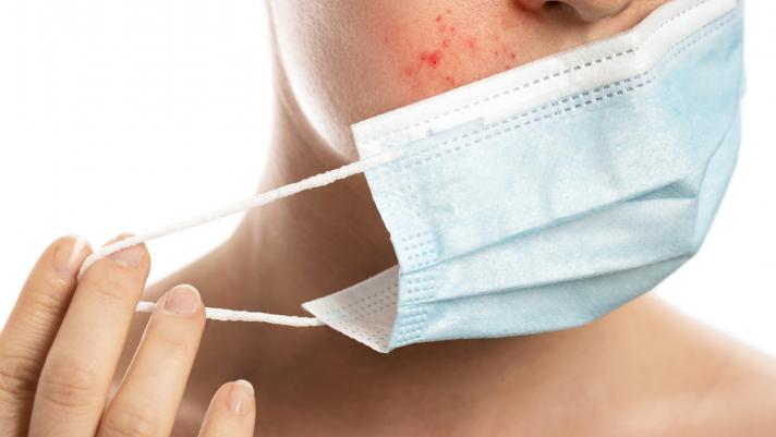 Prevenire e curare acne da mascherina