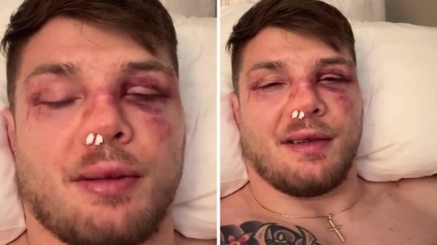 Marvin Vettori, viso tumefatto dopo la sconfitta contro Allen: "Sono dispiaciuto perché..."