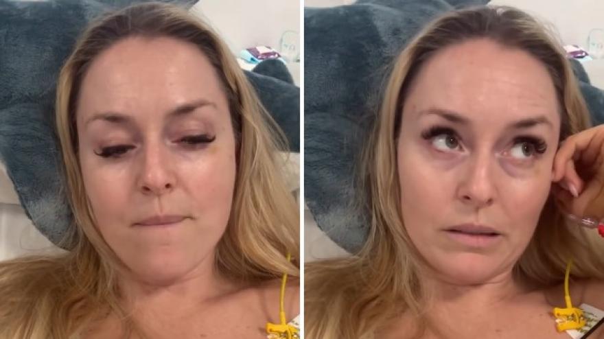 Vonn dall'ospedale: "Giorni duri, dovrò fare altri due interventi"