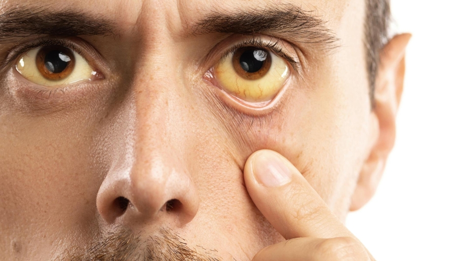 Man checking his health condition. Yellowish eyes is sign of problems with liver, viral infection or other disease.