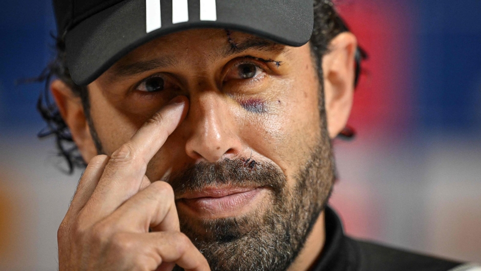 Lyons Italian head coach Fabio Grosso give a press conference in the Olympique Lyonnais' Groupama OL training centre in Decines-Charpieu, near Lyon, central-eastern France, on November 3, 2023. Lyon's coach Fabio Grosso suffered cuts to his face and needing stitches after the team's bus was stoned on October 29 as it entered the Stade Velodrome ahead of their macth against Marseille. (Photo by OLIVIER CHASSIGNOLE / AFP)