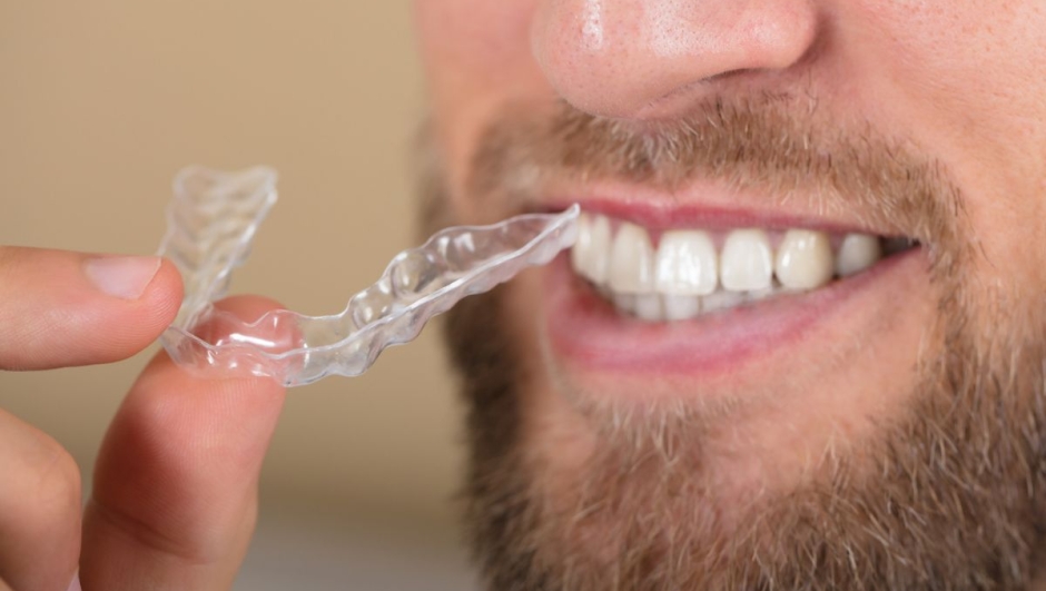 Bite dentale come e quando usarlo