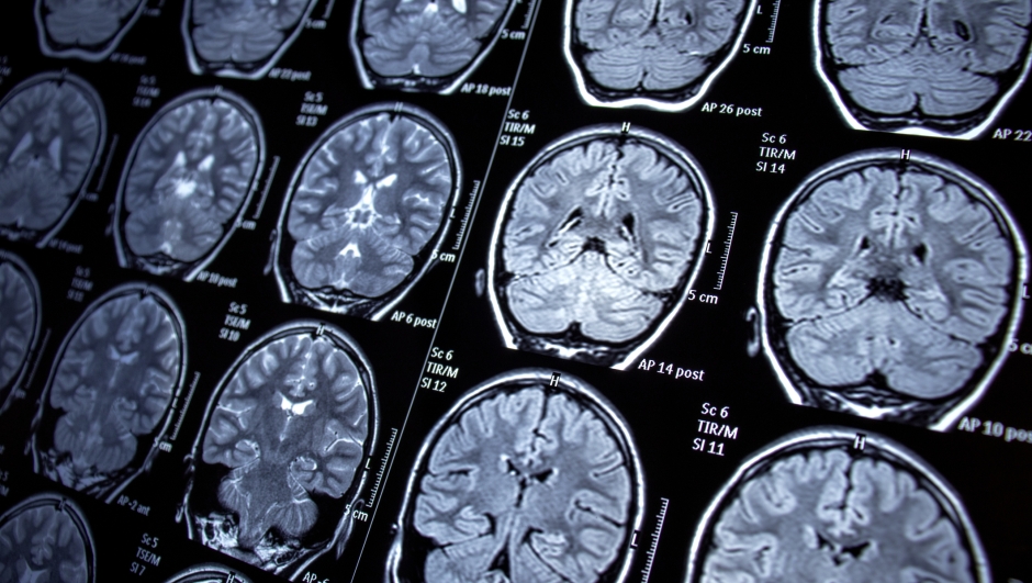 neurology, epilepsy, magnetic resonance imaging, mri, seizure, health