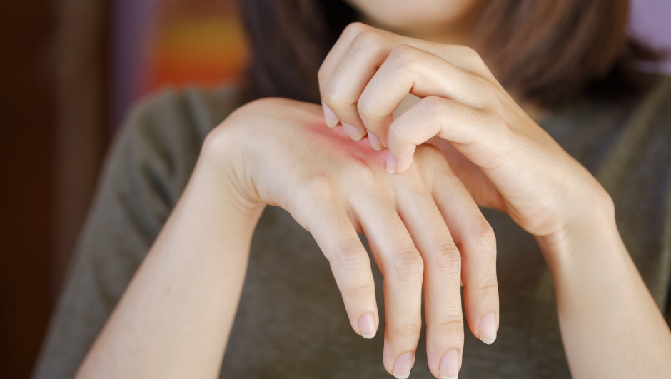 Asian woman is scratching a hand with a red rash on the back of the hand due to a foreign body allergy or insect bite.